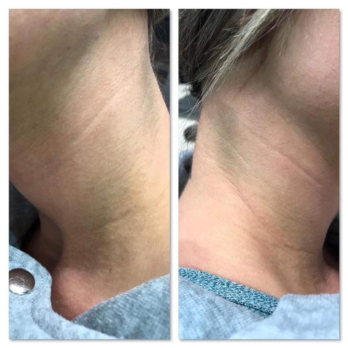 Ashley Schade, a Kadlec nurse, says a patient choked her while she was caring for him Sept. 16. The photos were taken after the incident. The patient has been charged with second-degree assault.