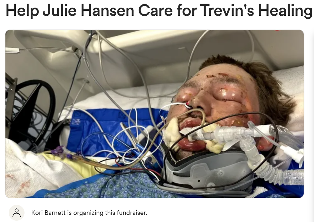 Trevin Hansen is being treated for burns over 65% of his body after trying to put out a fire the night of July 4 at his family’s mini storage business on East Reata Road in Kennewick. A GoFundMe has been started.