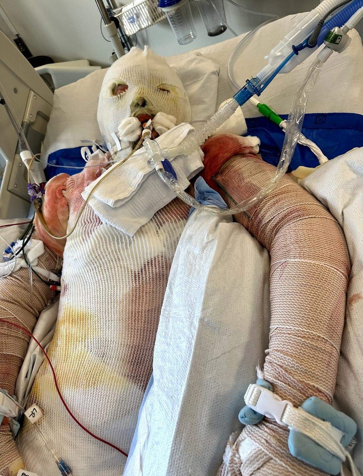 Trevin Hansen is being treated for burns over 65% of his body after trying to put out a fire the night of July 4 at his family’s mini storage business on East Reata Road in Kennewick