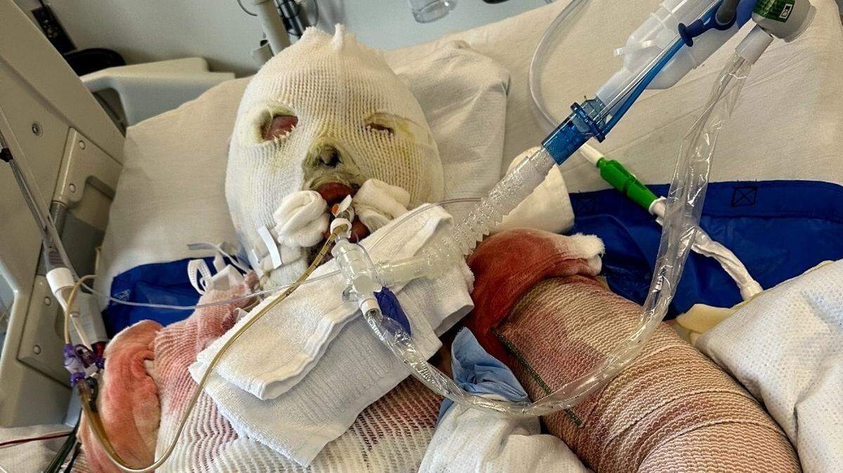 Trevin Hansen is being treated for burns over 65% of his body after trying to put out a fire the night of July 4 at his family’s mini storage business on East Reata Road in Kennewick