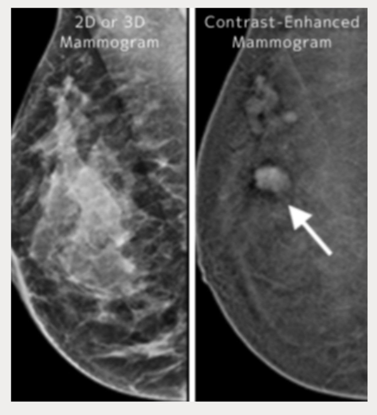 Dense breast tissue and cancer both appear white on a standard mammogram. But combining the use of contrast dye with a mammogram eliminates that confusion to make a tumor more obvious, even in its earliest stages.