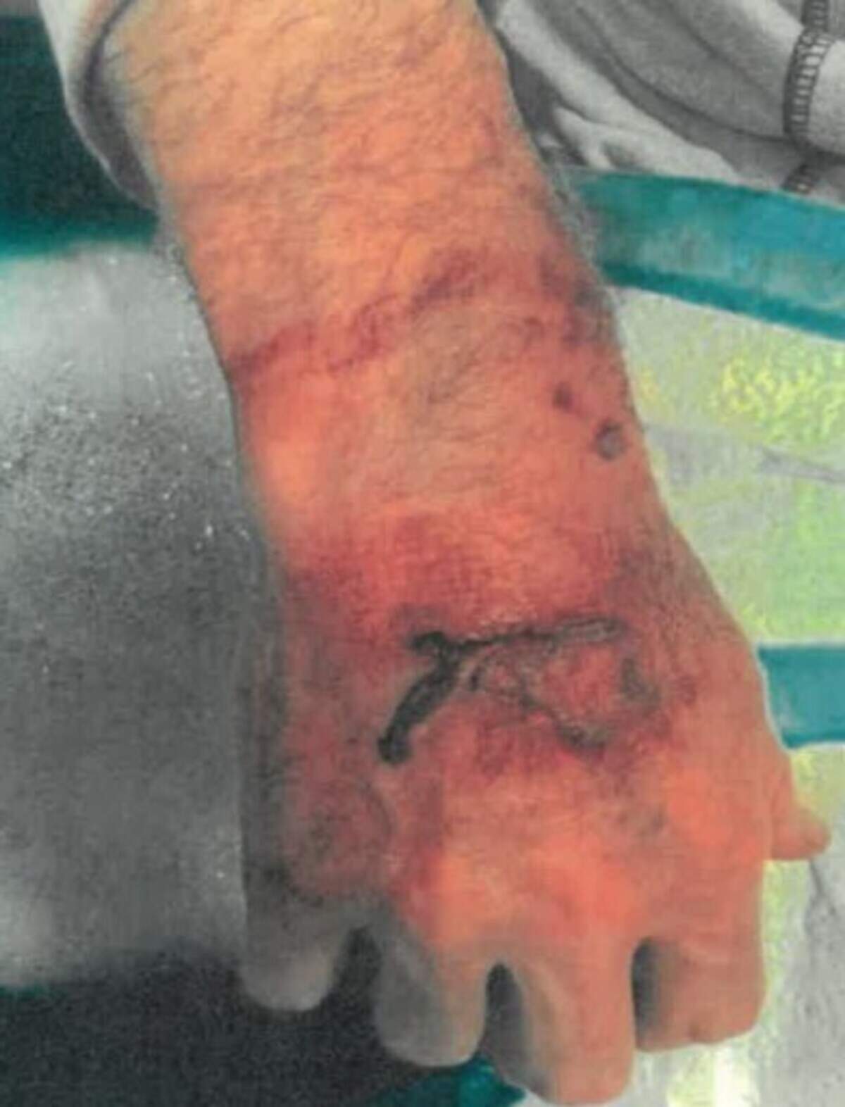 One of the six people bitten by Stan at the Tri-Cities Animal Shelter in Pasco.
