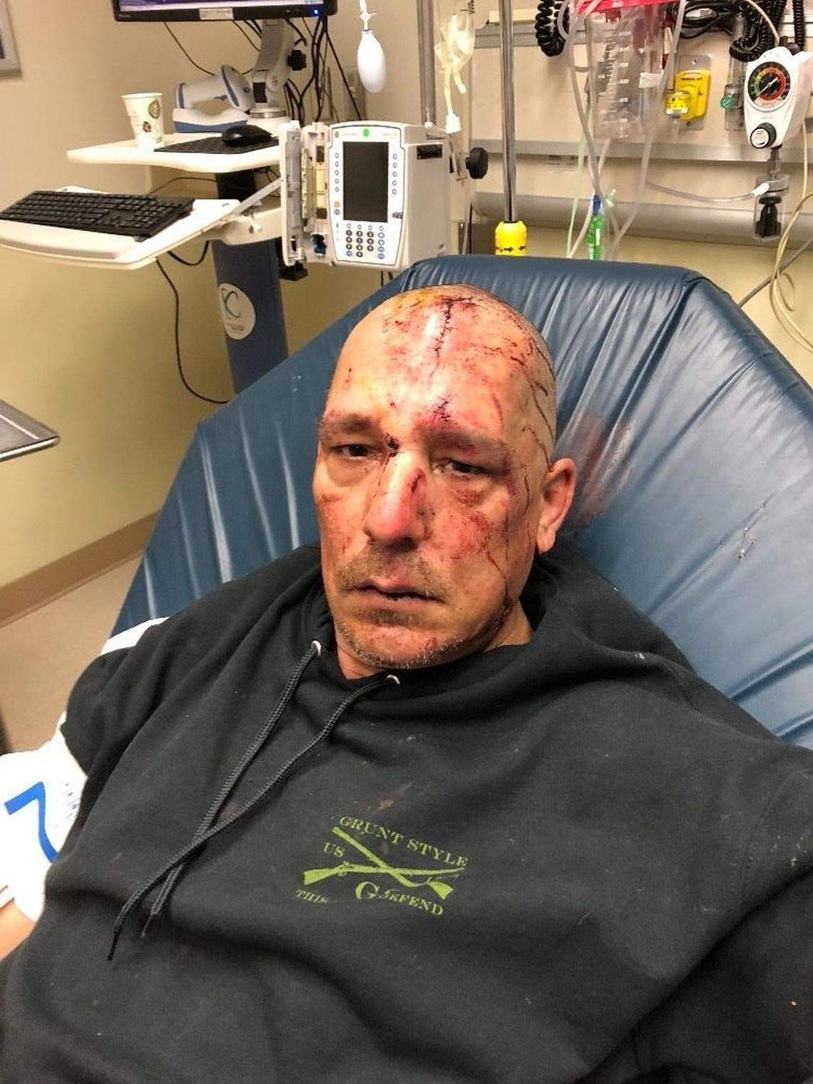 Cuts from glass broken during a seizure have required Bill Evans of Richland to get up to 30 stitches at a time.